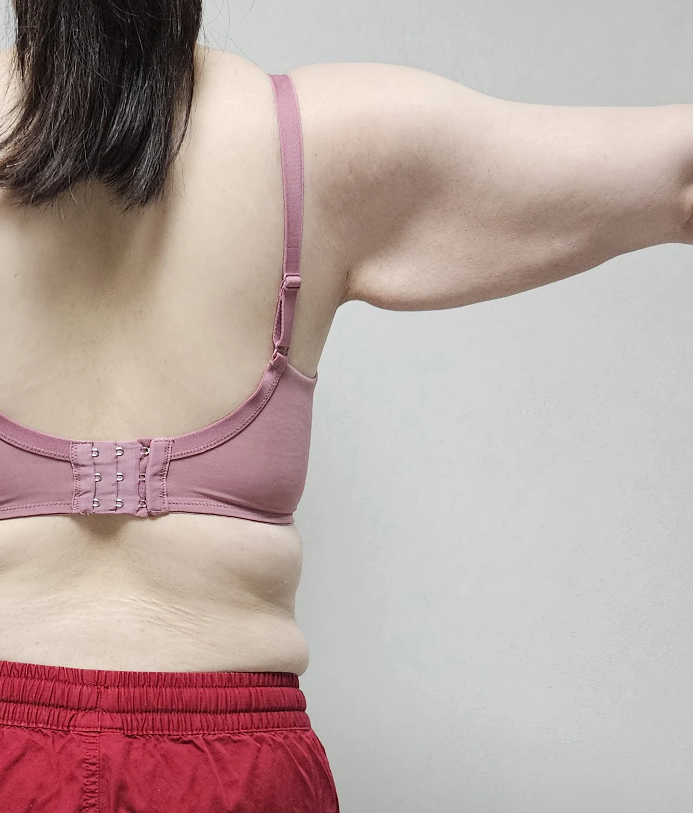 Posting my arm lipo revision and arm lif - Body Contouring Before 2 - TheLINE Plastic Surgery
