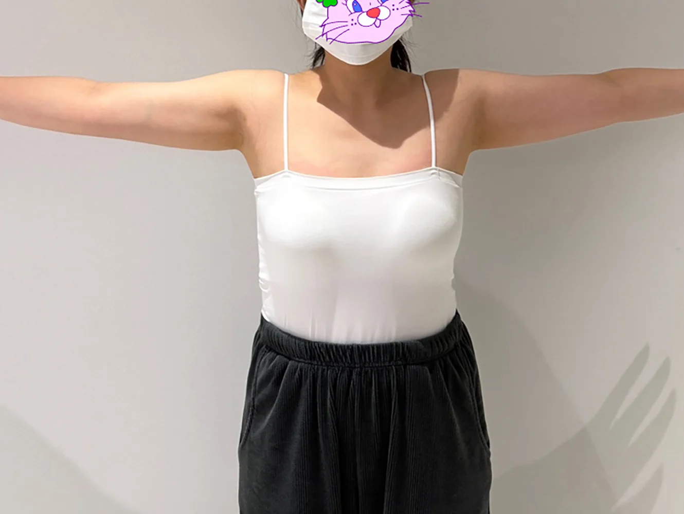 One month after arm lipo - Arm Liposuction surgery Before photo - TheLINE Plastic Surgery