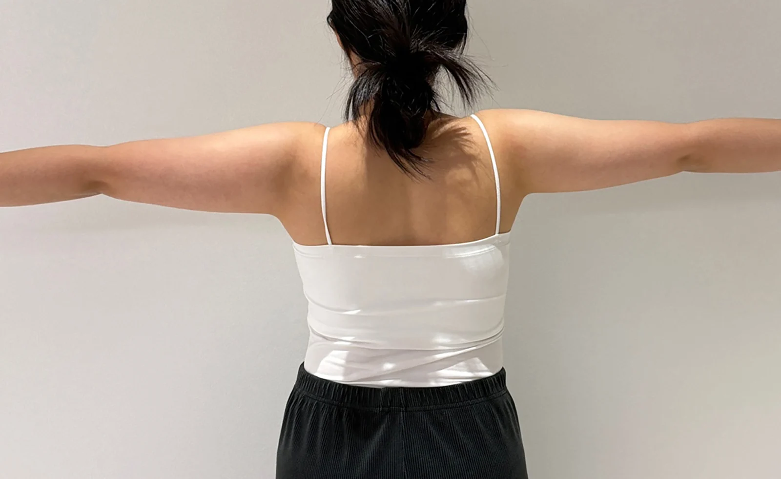 One month after arm lipo - Arm Liposuction Before 2 - TheLINE Plastic Surgery