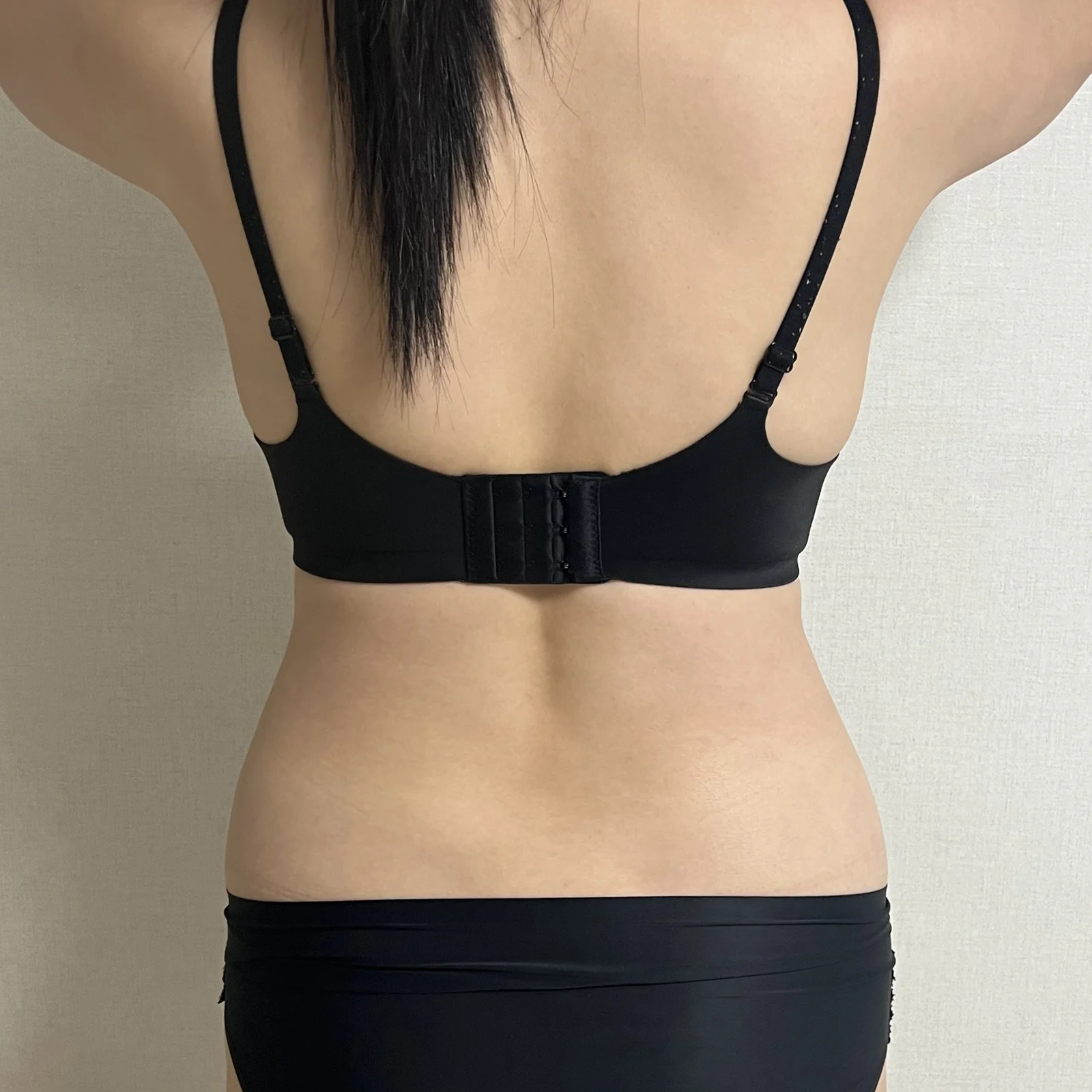 I had abdomen and love handle surgery wi - Abdominal Liposuction (Upper Body) Before 2 - TheLINE Plastic Surgery