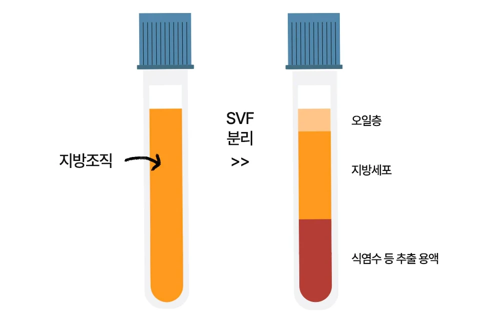 지방조직에서 오일층·지방세포·추출 용액으로 나뉘는 SVF 분리 과정 - 더라인성형외과
