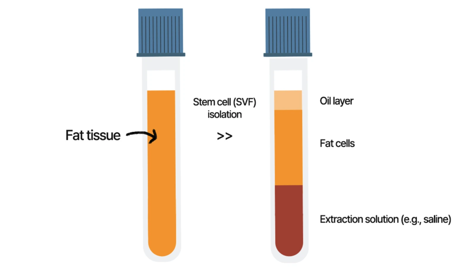 SVF separation process dividing fat tissue into an oil layer, fat cells and extraction solution - TheLINE Plastic Surgery