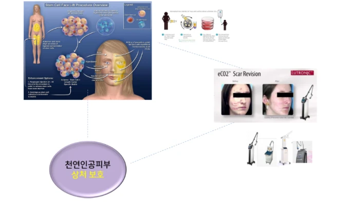 더라인 SVF 흉터치료 피부 전 층 리모델링 - 더라인성형외과