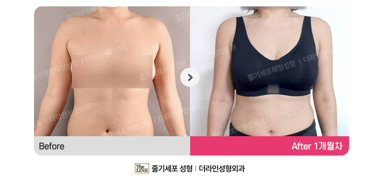 SVF 빼라빼라 지방흡입주사 전후사진 정면 (수술 전) - 더라인성형외과
