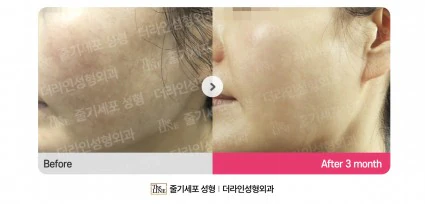 줄기세포 기미치료 전후사진 수술 전 - 더라인성형외과