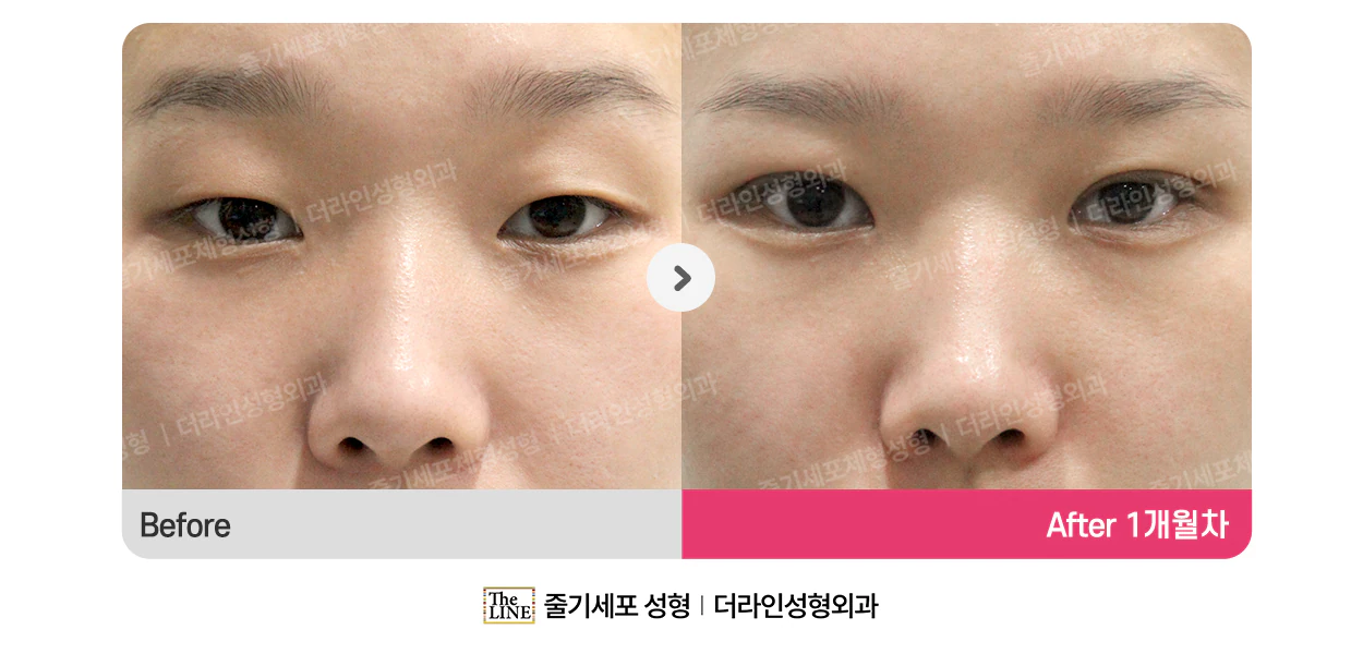 SVF 상안검 전후사진 정면 (수술 전) - 더라인성형외과