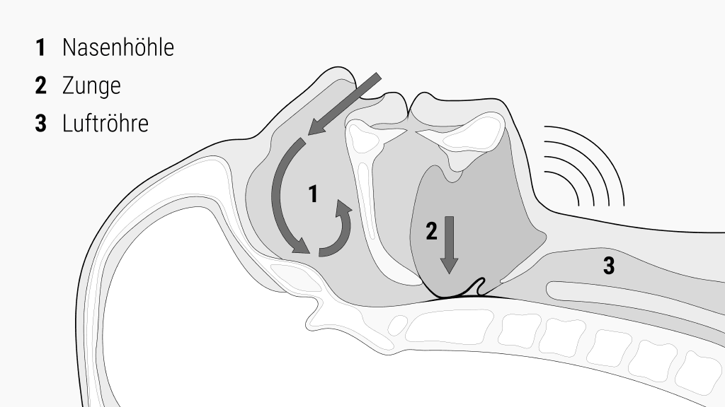 Illustration zeigt Entstehungsorte des Schnarchens: Nasenhöhle, Zunge und Luftröhre