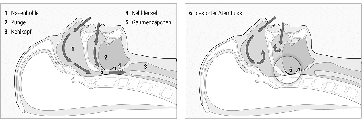 Illustration: Zwei Köpfe im Querschnitt: links gesunder Atemfluss, rechts gestörter Atemfluss. Der Atemfluss ist mit Pfeilen dargestellt, daneben stehen die Etappen der Atmung: Nasenhöhle, Zunge, Kehlkopf, Kehldeckel, Gaumenzäpfchen.