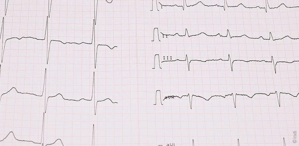 Foto „Puls im Schlaf visualisieren“: Ein Herzfrequenz-Diagramm auf einem EKG-Ausdruck.