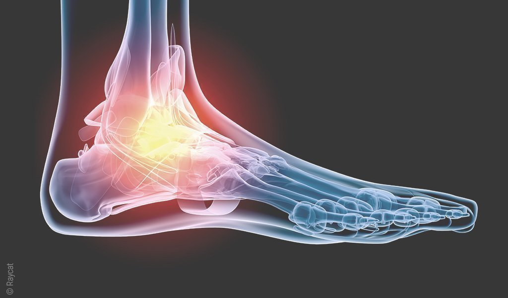 Illustration: Röntgenbild eines Fußgelenks; das Sprunggelenk leuchtet wie eine Flamme.