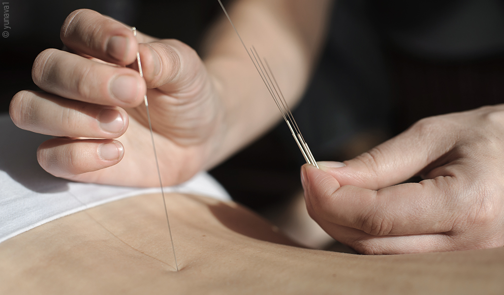 Foto: Eine Hand sticht eine Akupunkturnadel in den Rücken einer anderen Person; die andere hält weitere Akupunkturnadeln.