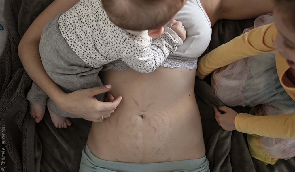 Foto aus Vogelperspektive: Eine erwachsene Person liegt in Rückenlage auf dem Bett. Ihr Bauch ist entblösst und lässt den Blick auf Dehnungsstreifen, Narben und weitere Folgen einer Schwangerschaft für die Haut zu. Neben und über der Person sitzen und kuscheln zwei Kinder. 