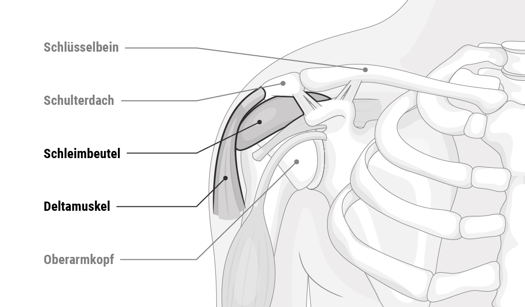 Illustration: Die Anatomie eines menschlichen Schultergelenks; eine sogenannte Igelgrafik zeigt wo Schlüsselbein, Schulterdach, Schleimbeutel, Deltamuskel und Oberarmkopf liegen.