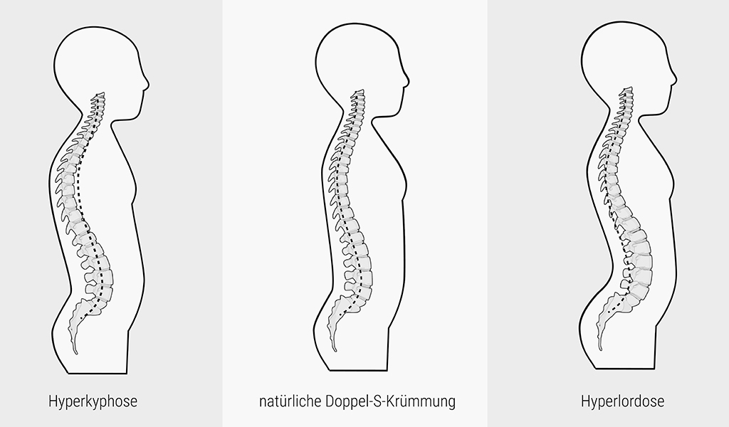 Drei Illustrationen der menschlichen Wirbelsäule: Links eine Hyperkyphose (Rundrücken), mittig eine natürliche Doppel-S-Krümmung, rechts eine Hyperlordose (Hohlkreuz).