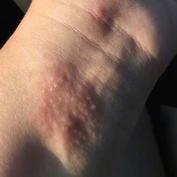 Poison ivy rash blisters