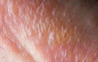 Blisters from poison ivy rash