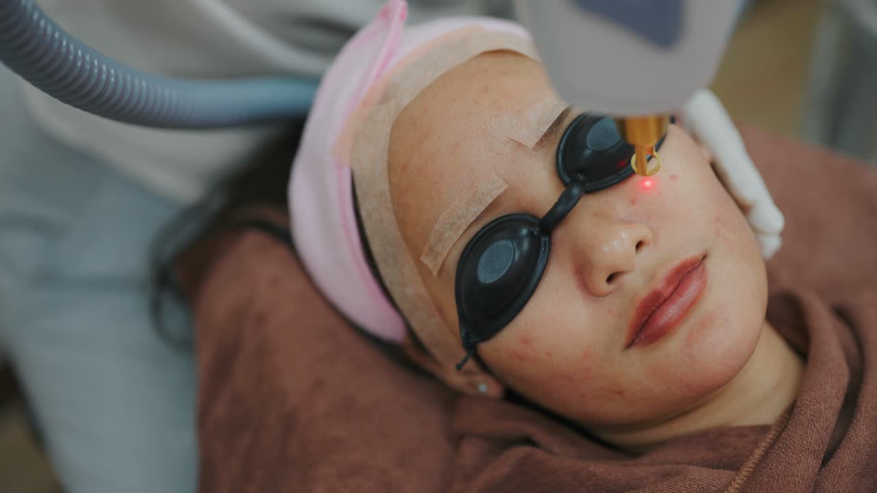 Melasma & Sunspot Treatment