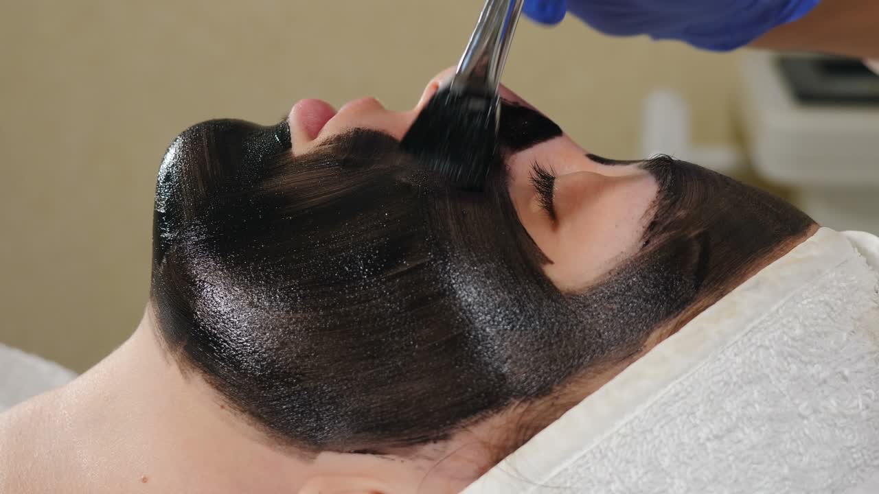 Carbon Laser Facial