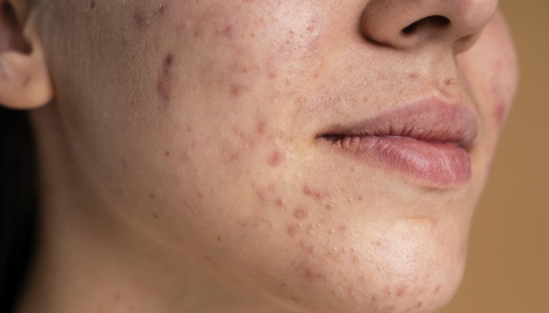 Cicatriz de acne