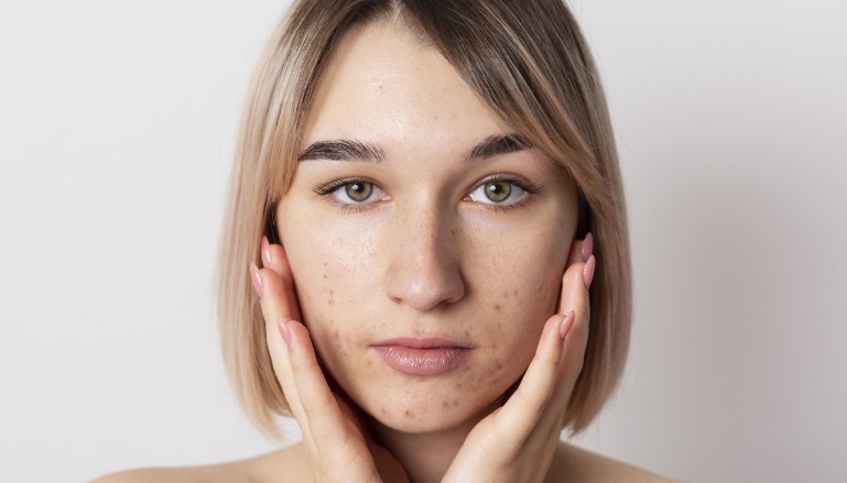 Mulher branca com as mãos sofre a face e algumas espinhas nas bochechas.