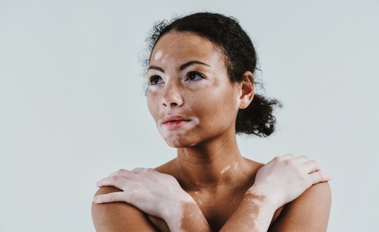 Moça com vitiligo