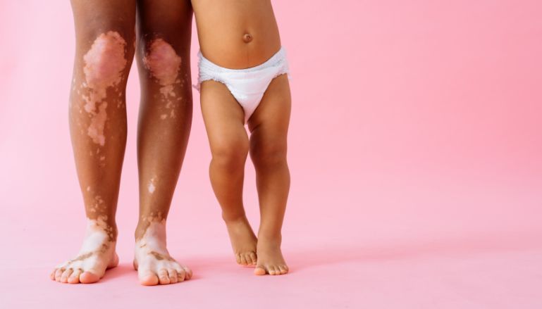 Pernas de pessoas com vitiligo