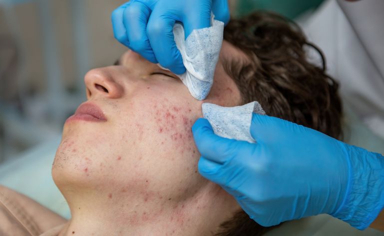 Pessoa tratando acne fungica com dermatologista