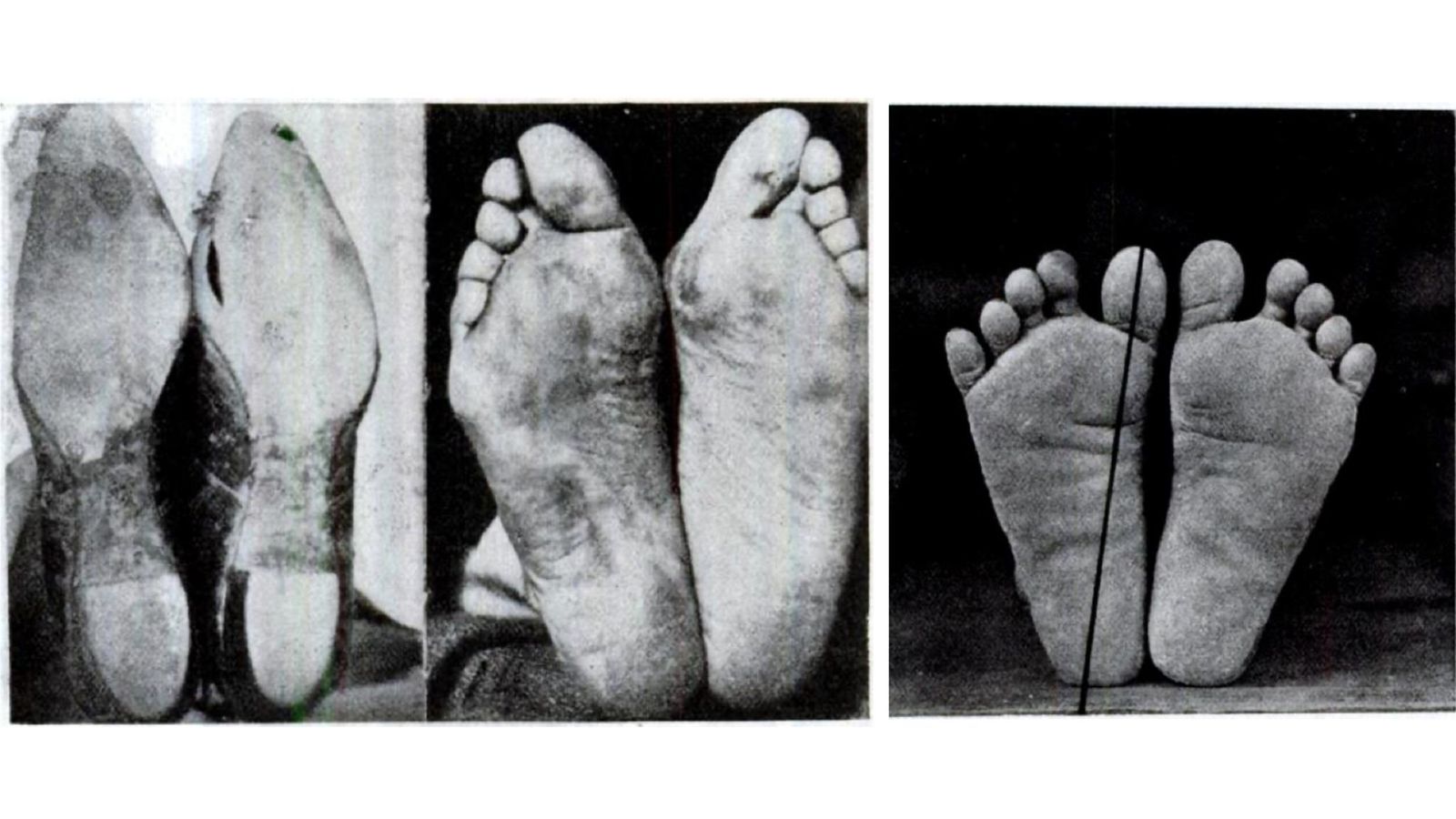 Feet deformed from years of shoe wear compared to the natural shaped feet of a barefooter (Source: https://myfootfunction.com/blogs/barefoot-research/comparison-between-shoe-wearing-population-and-barefoot).