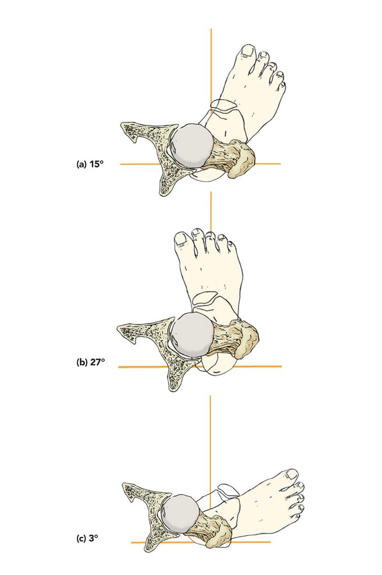 Bernie Clark's book shows the angle of the head of the thigh bone in relation to the foot in different people who would find it difficult to keep their feet comfortably parallel