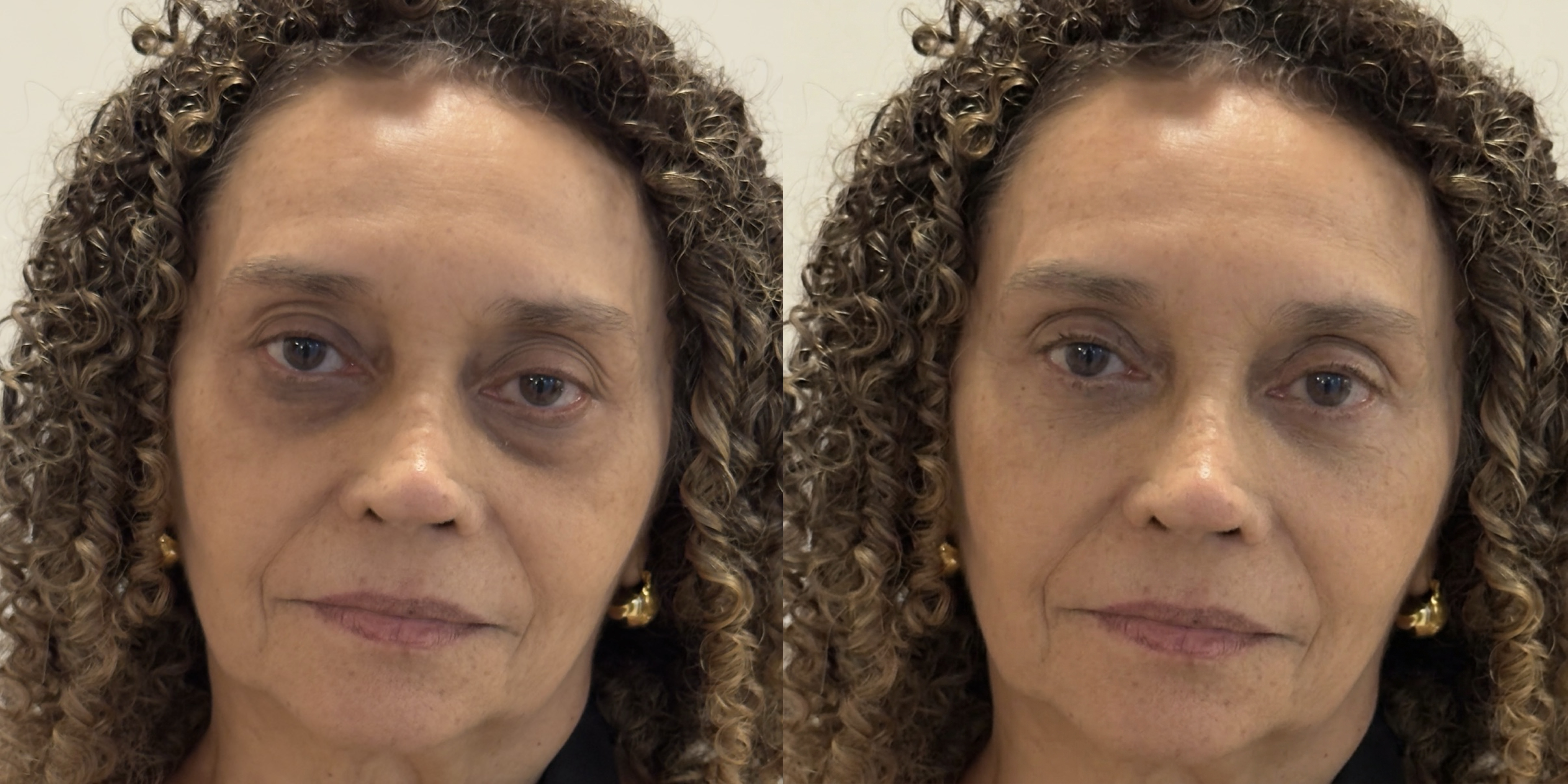 Blepharoplasty Simulation Comparison