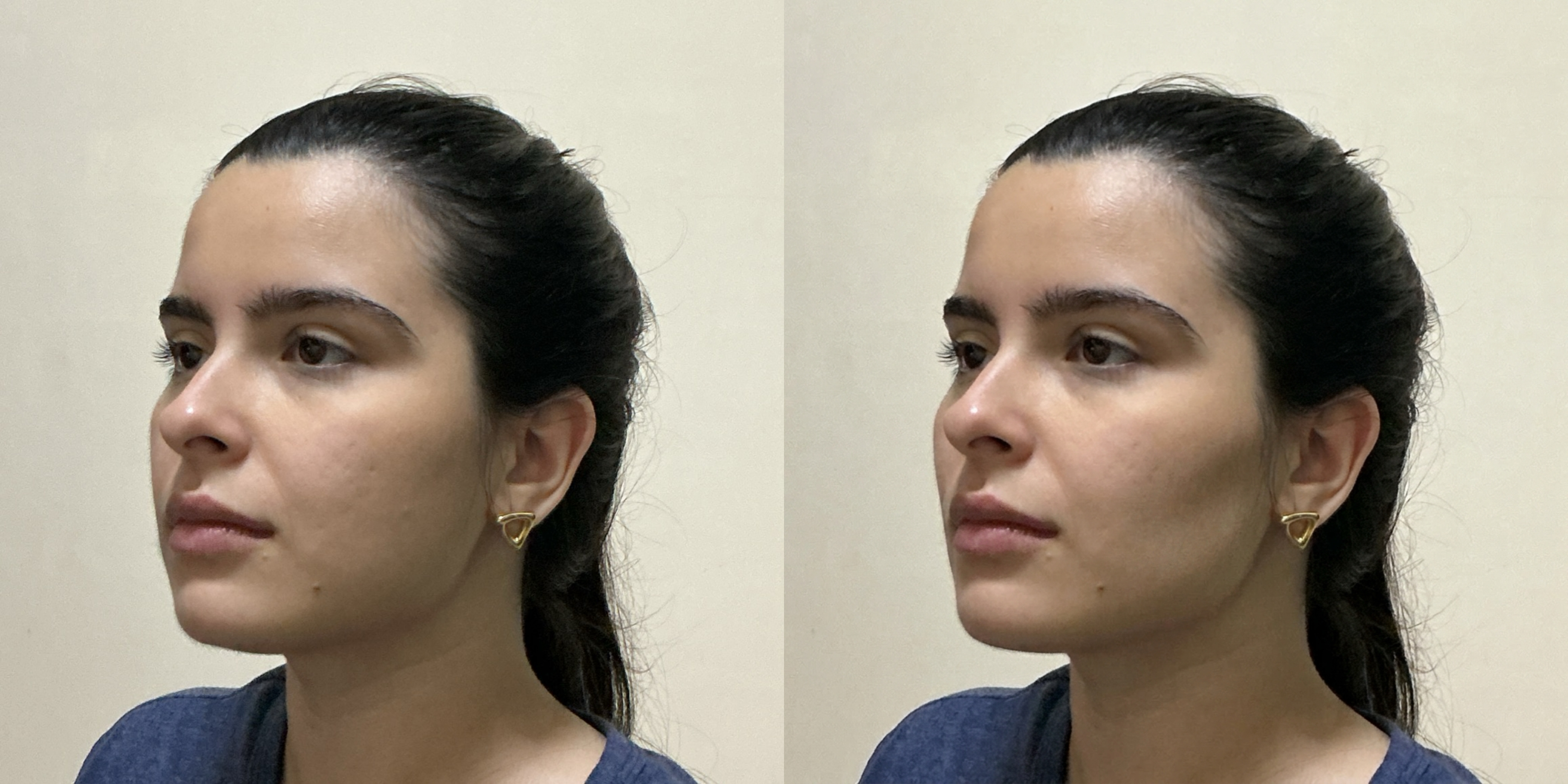 Frontal Buccal Fat Removal Simulation Comparison