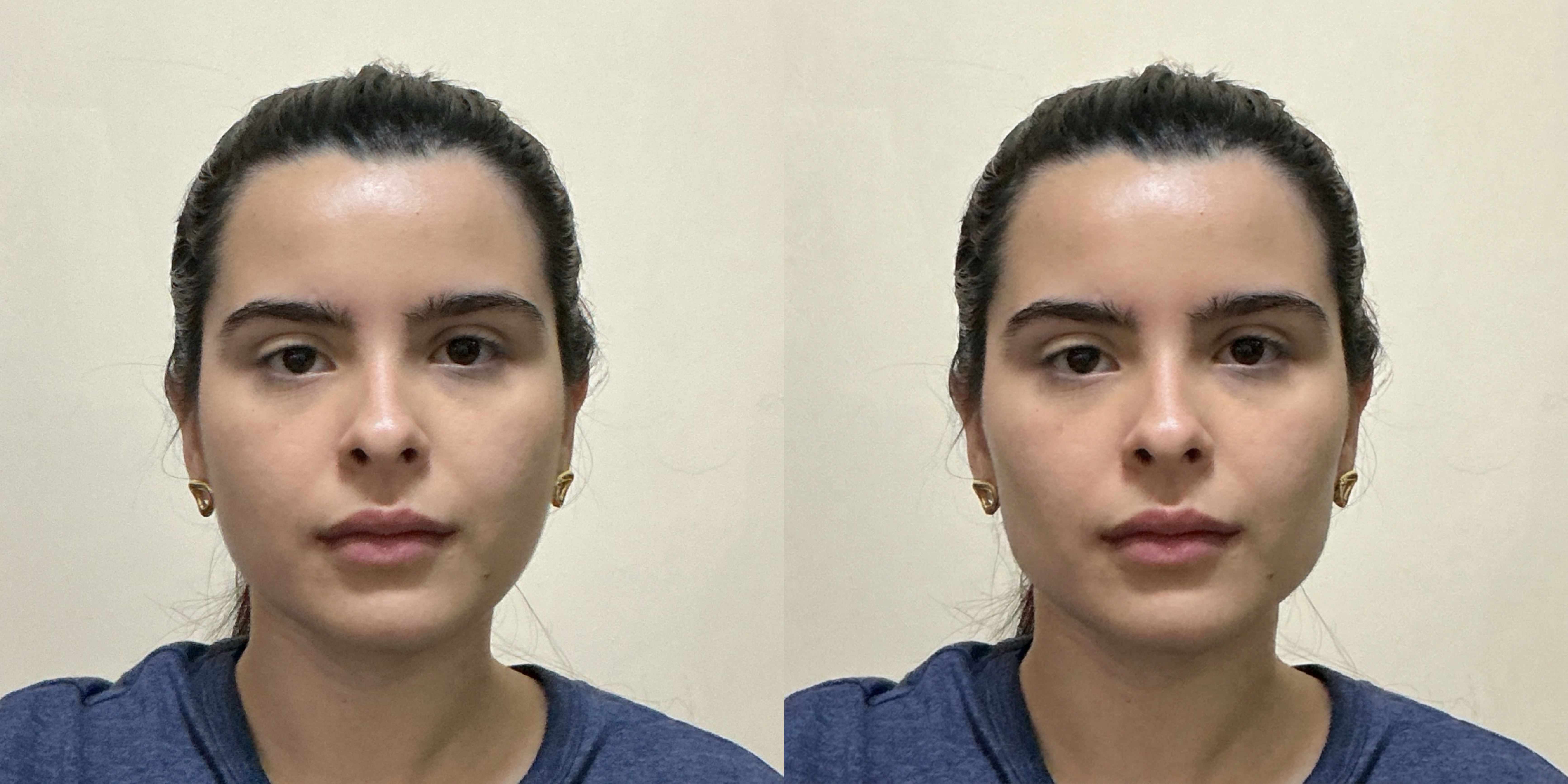 Lateral Buccal Fat Removal Simulation Comparison