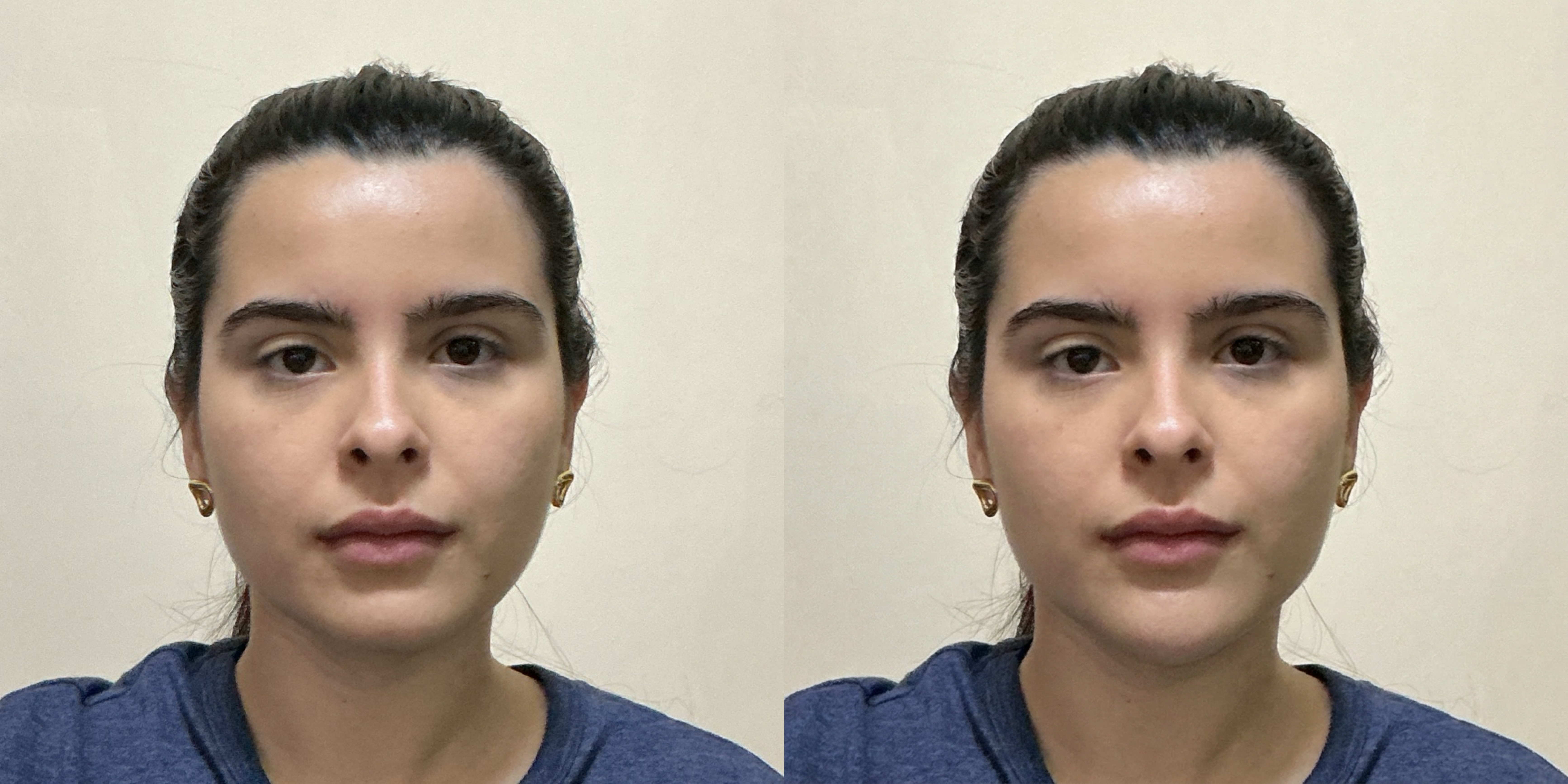 Frontal Chin Augmentation Simulation Comparison