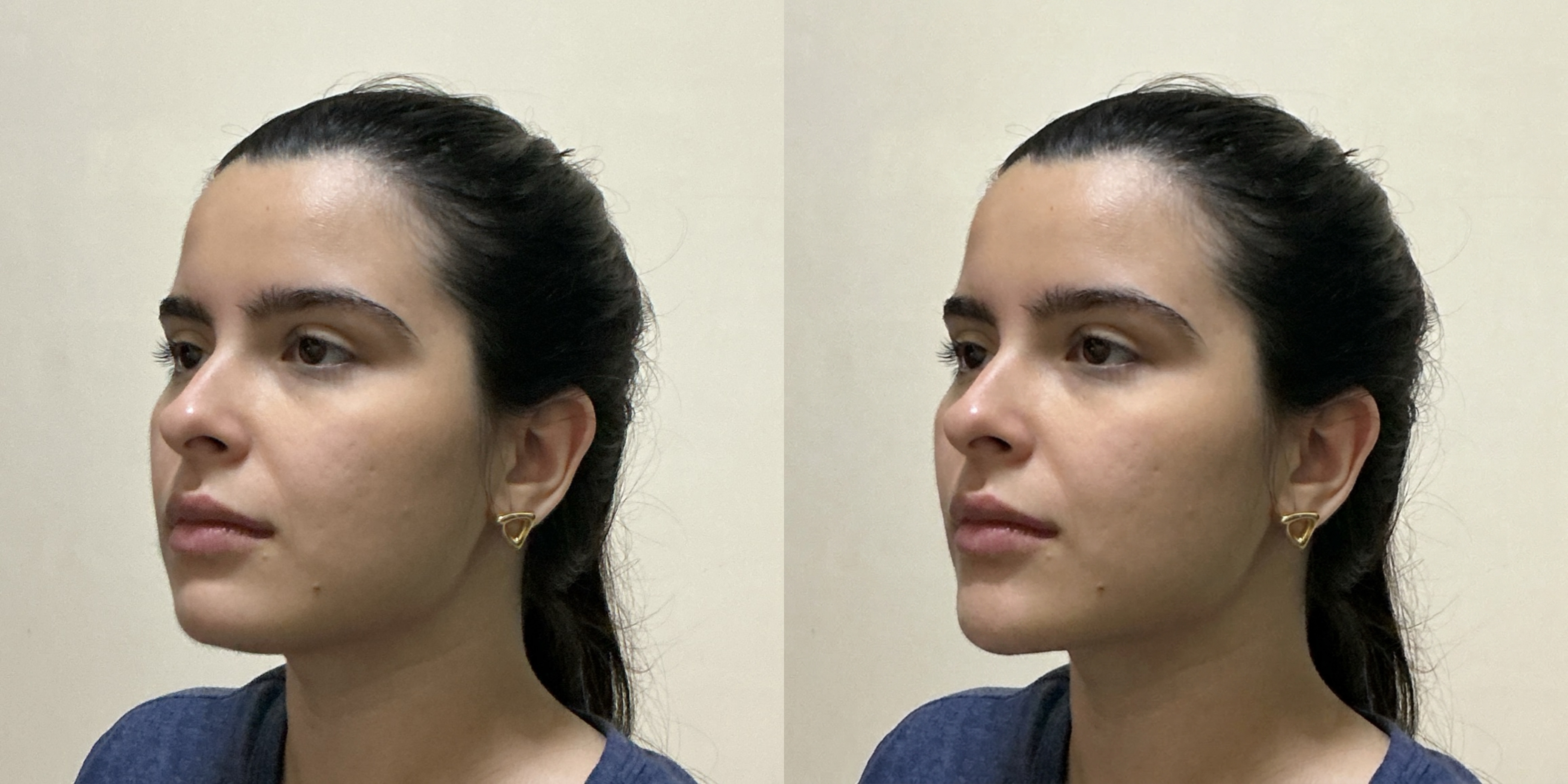 Lateral Chin Augmentation Simulation Comparison