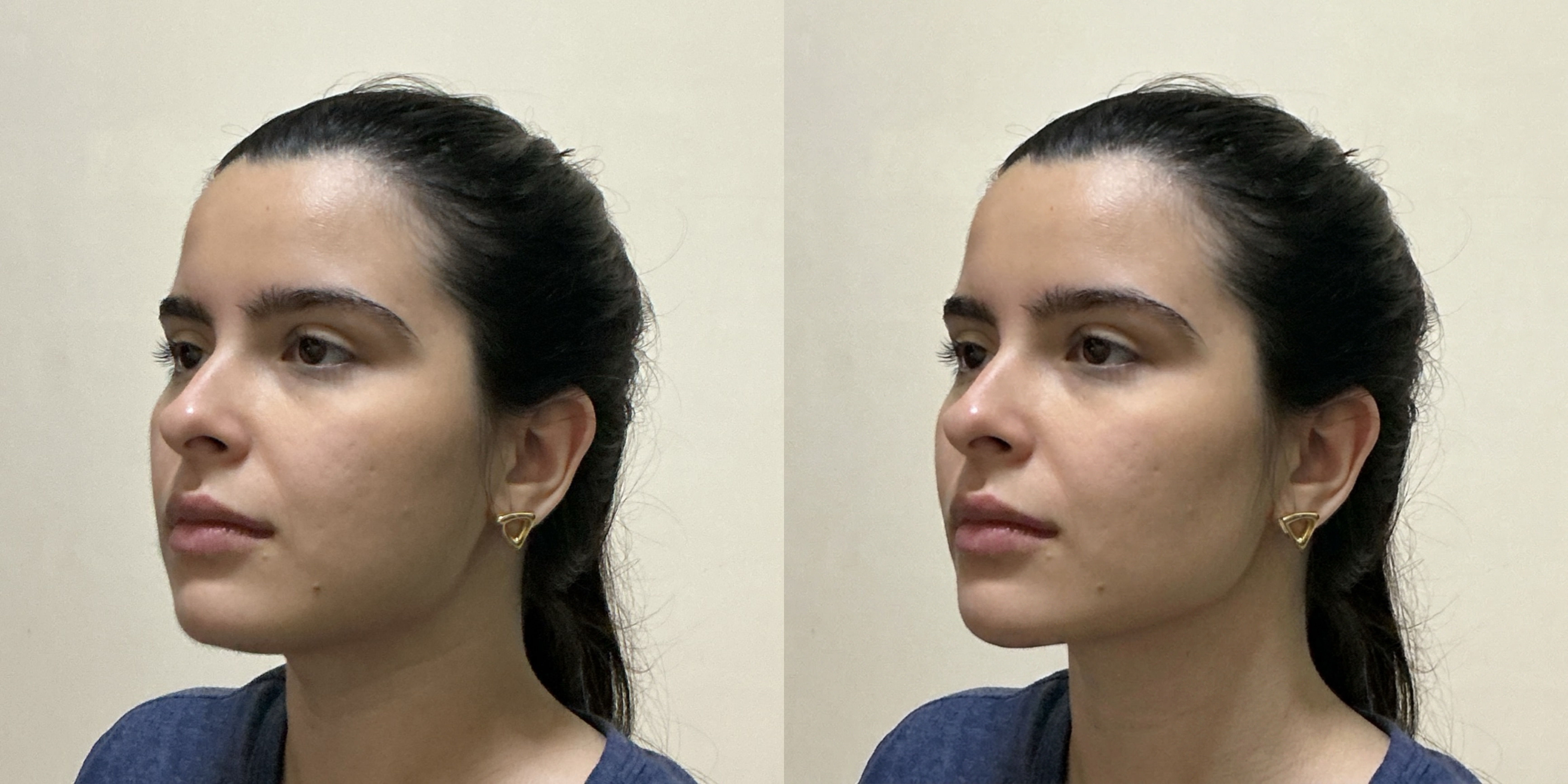 Facelift Simulation Comparison