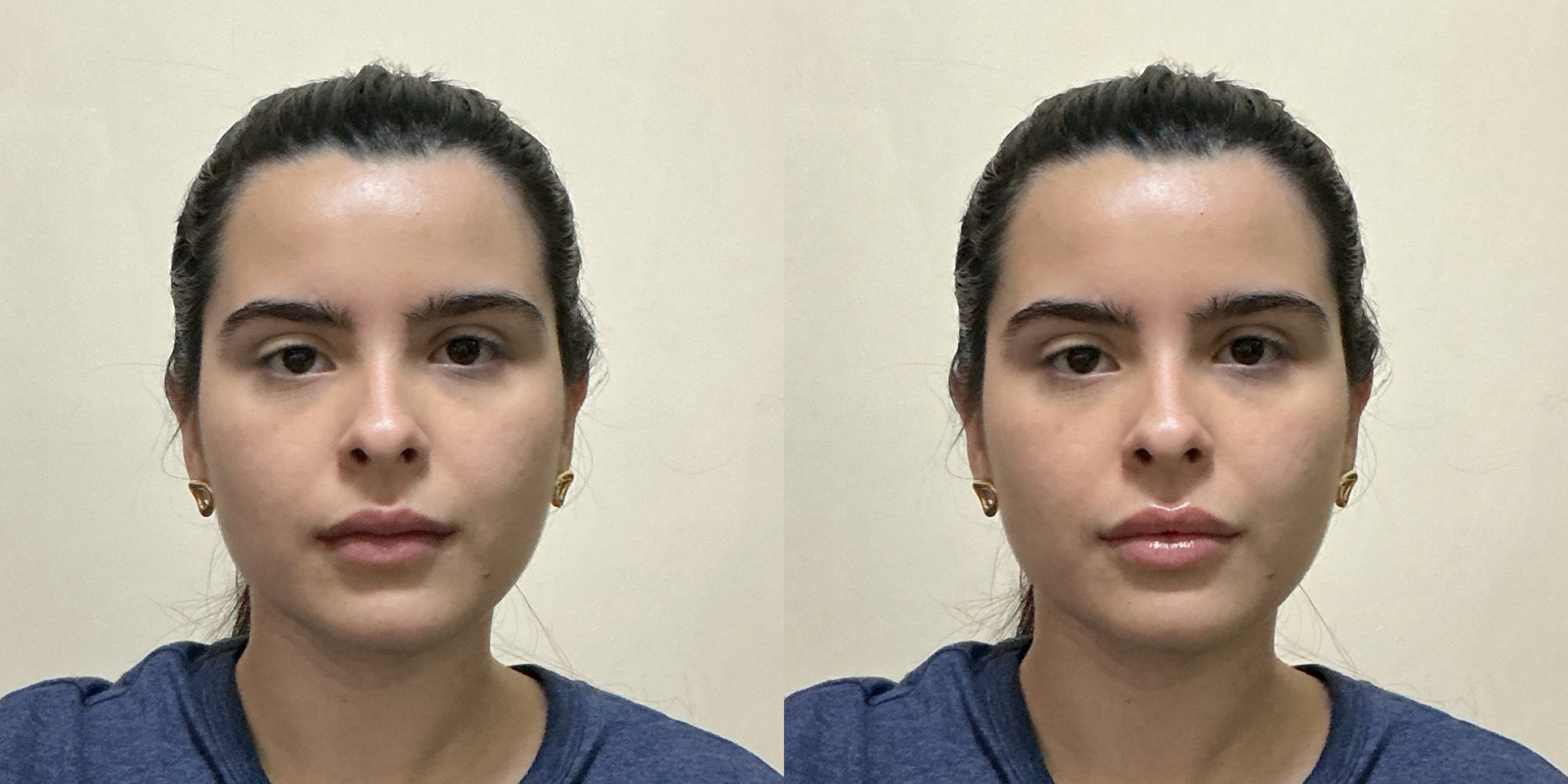 Lip Lift Simulation Comparison 1
