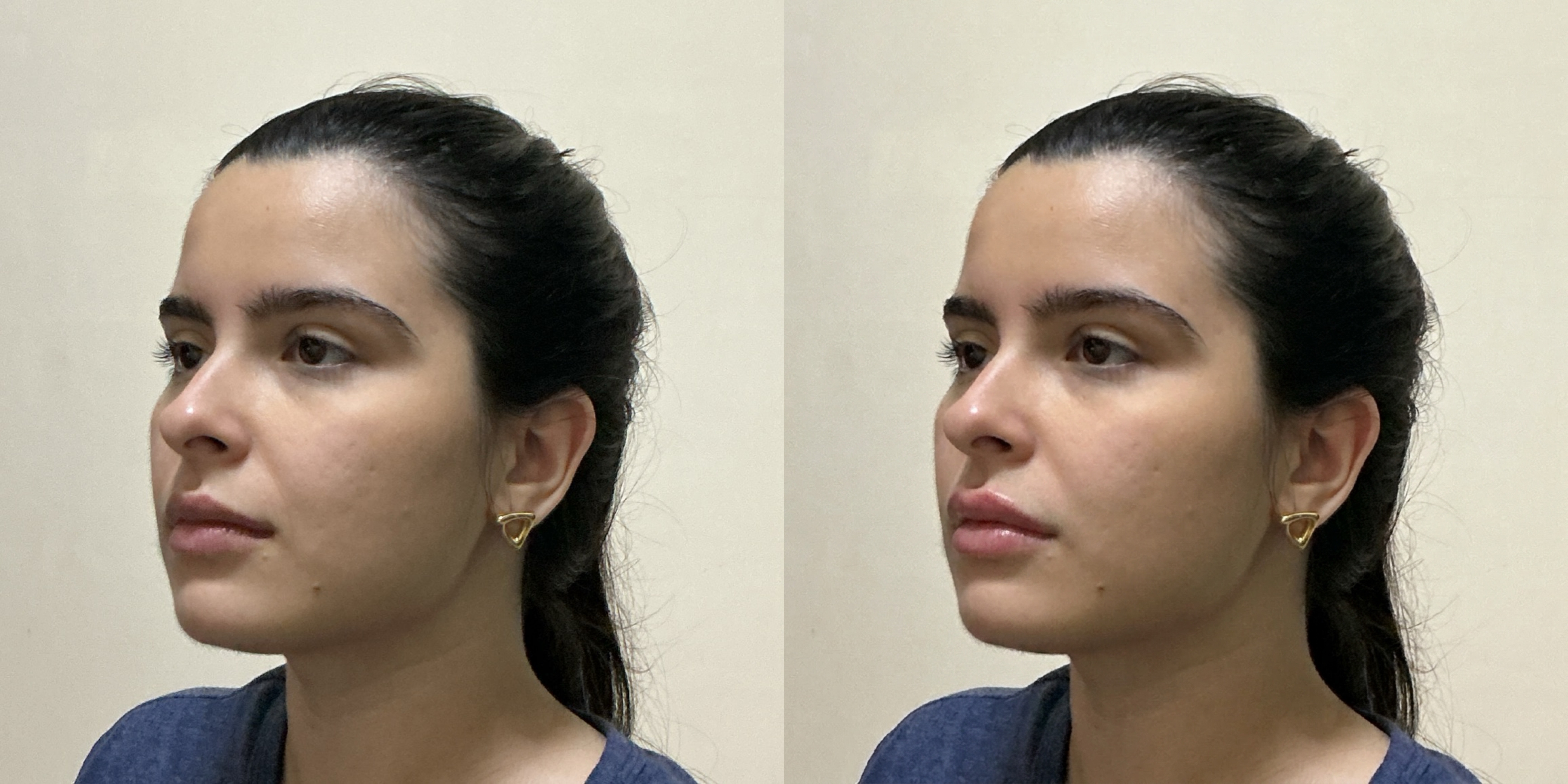 Lip Lift Simulation Comparison 2