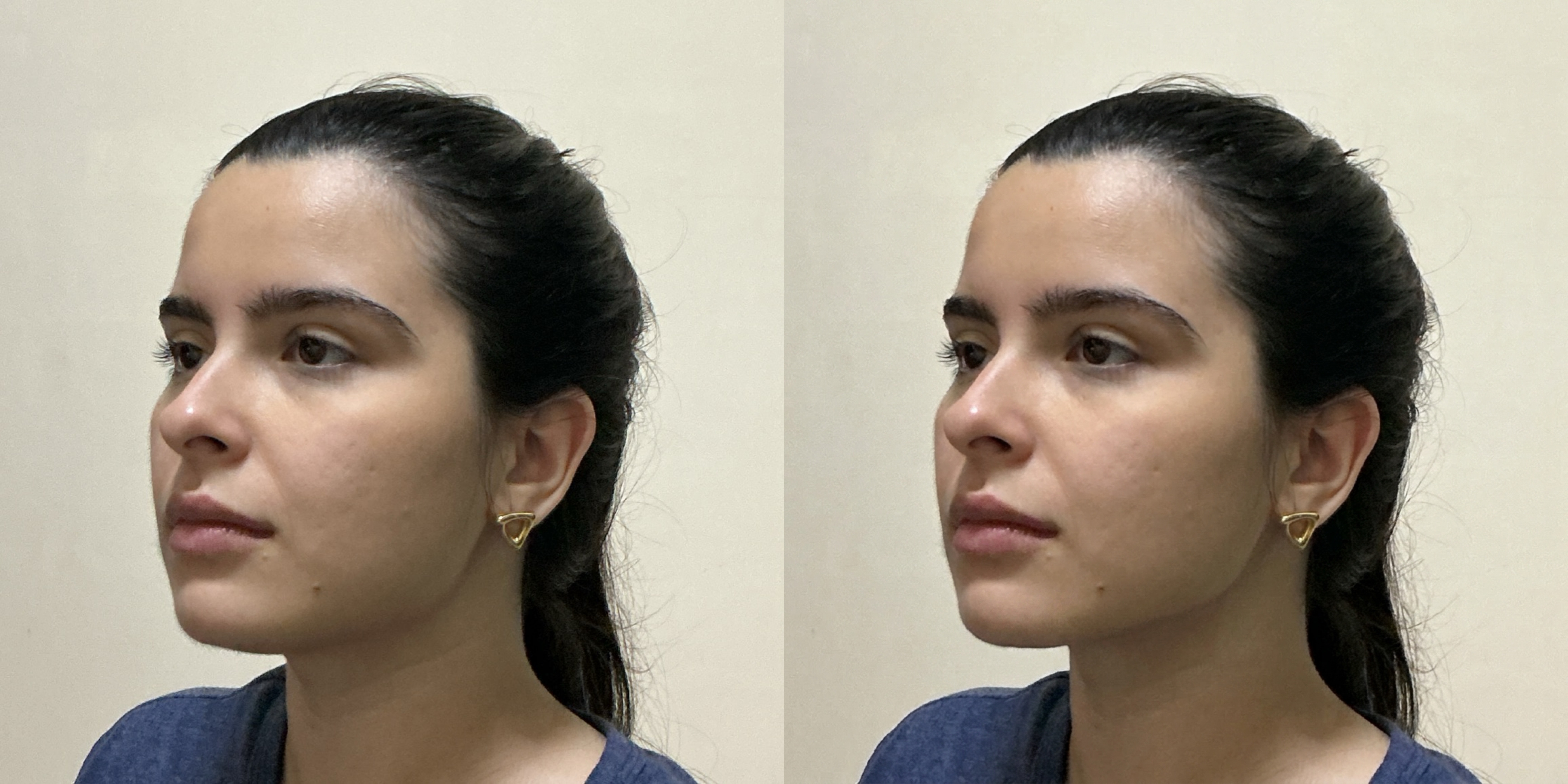 Neck Lift Simulation Comparison