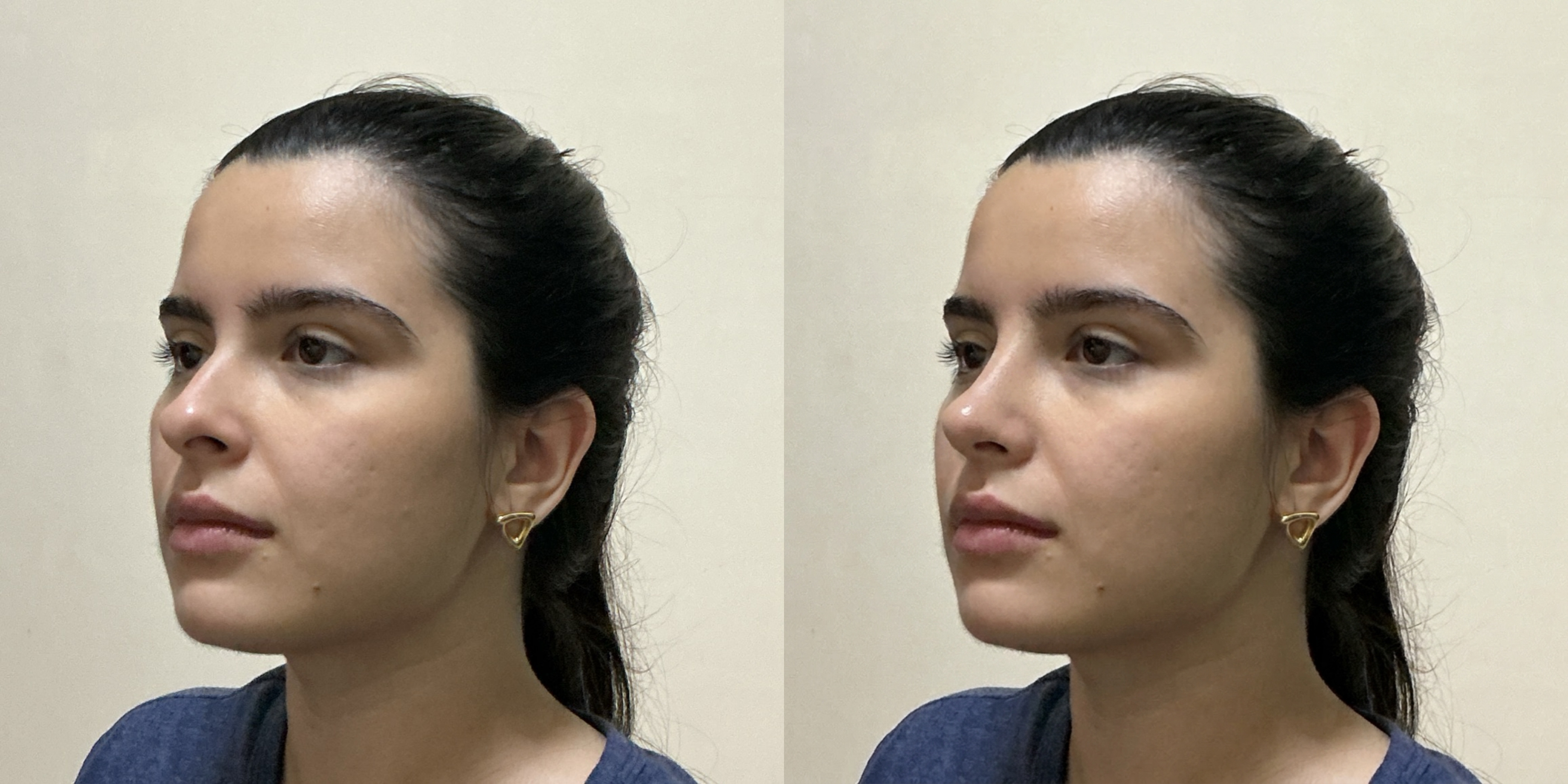 Lateral Rhinoplasty Simulation Comparison