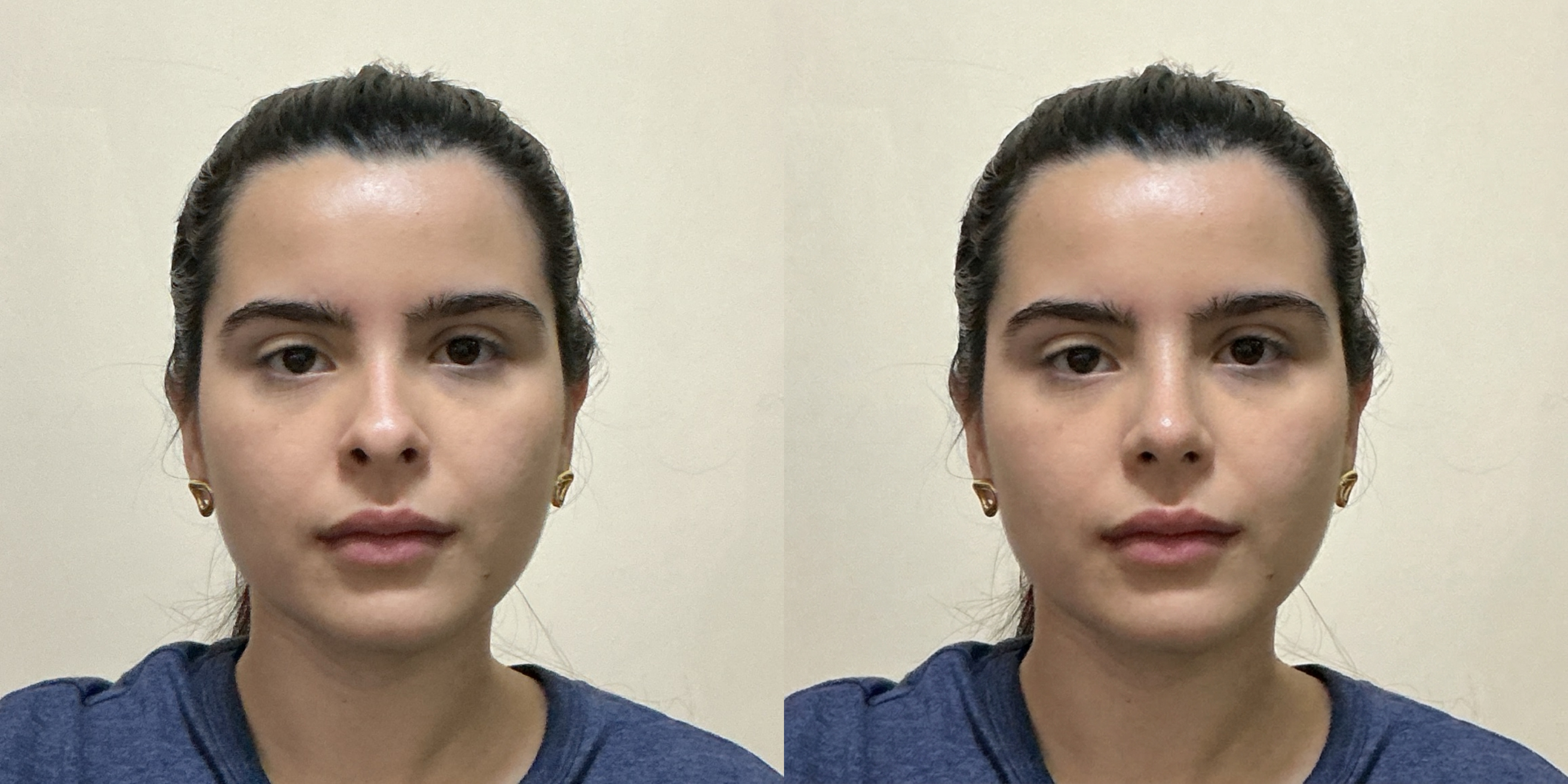 Frontal Rhinoplasty Simulation Comparison
