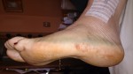 My broken ankle