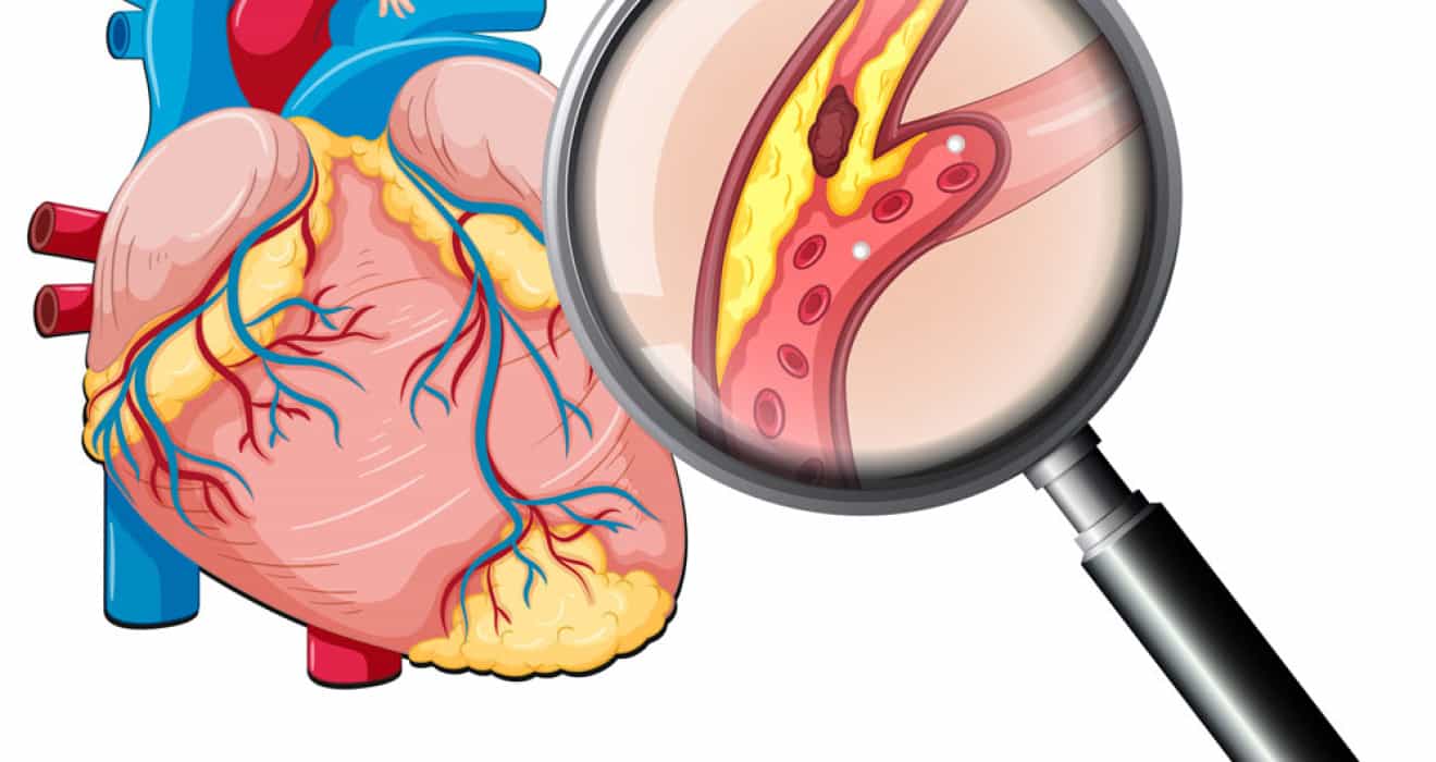 Optimizing Heart Health: Effective Cholesterol Treatment Strategies
