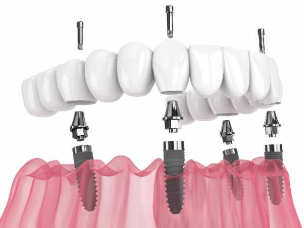 How Dental Implants Work: A Comprehensive Overview