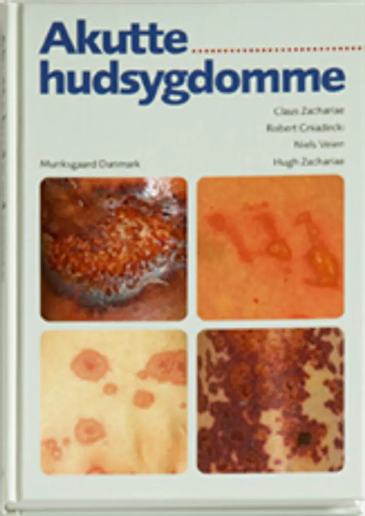 Akutte hudsygdomme af Claus Zachariae m.fl.
