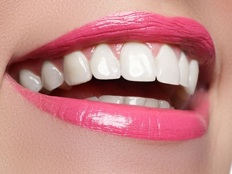 Porcelain Veneers Can Give You a Hollywood Smile