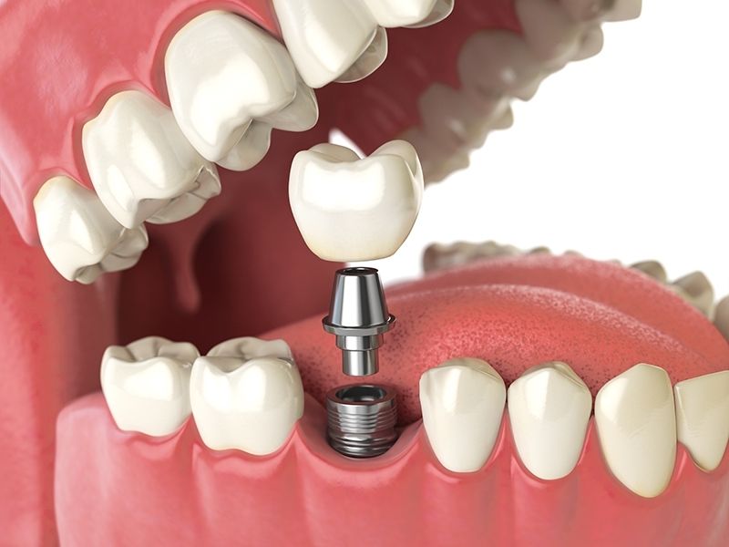 How Dental Implants Were Invented