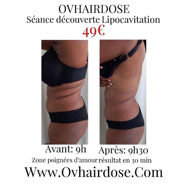 Ovhairdose : Lipocavitation + Radiofrequence + Electrosimulation Lipolaser