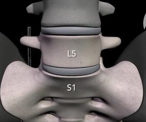 vertebres lombaires l5 s1