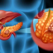 Perspectiva digital sobre a atuação do câncer de pâncreas