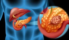 Perspectiva digital sobre a atuação do câncer de pâncreas